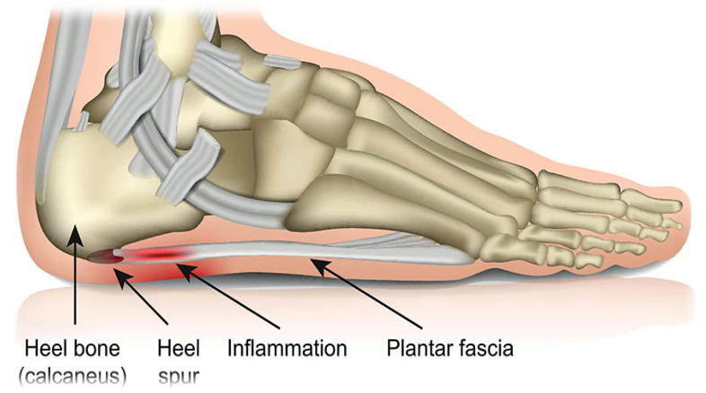 Weight sometimes over-flattens plantar fascia. SprinSole utilizes a non-flattened arch design for customized support