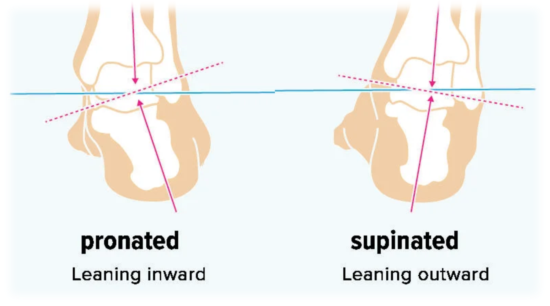 A loaded foot exacerbates supination or pronation issues. SprinSole features a neutral arch design for better alignment